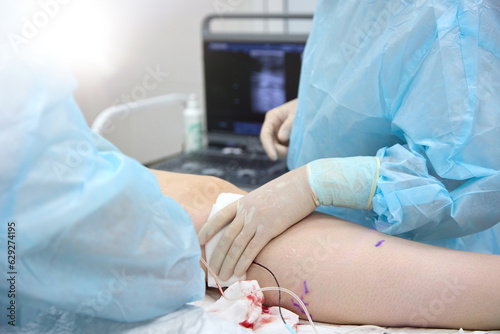 An assistant in a blue medical gown assists the doctor in performing surgery on the leg. Catheter was installed on the operating table for radiofrequency coagulation of the vein