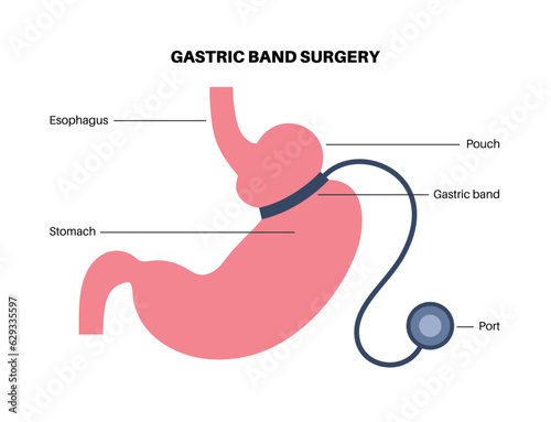 Gastric band poster