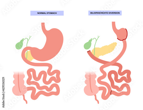 Biliopancreatic diversion procedure