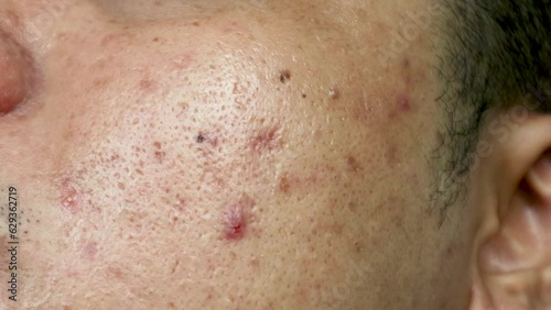 skin problems. problem of inflamed acne on the face. Inflamed acne consists of swelling, redness, and pores that are severely clogged with bacteria, oil, and dead skin cells.