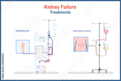 medical illustration Treatment of kidney failure. Hemodialysis and Peritoneal dialysis.Vector illustrations flat style.health care and medical concepts.