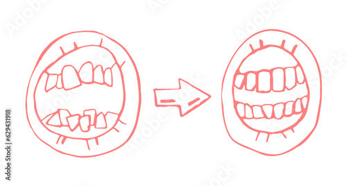 Orthodontic treatment result. Stomotology, orthodontics therapy concept.