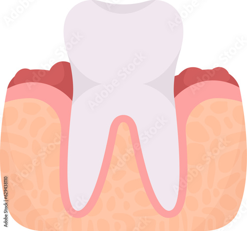 Gingivitis Tooth Problem