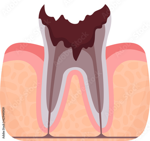 Dead Tooth Problem