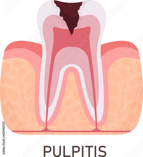 Pulpitis Tooth Problem