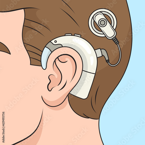 Cochlear implant on human head diagram schematic vector illustration. Medical science educational illustration photo