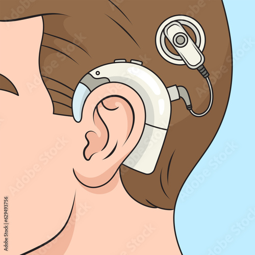 Cochlear implant on human head diagram schematic vector illustration. Medical science educational illustration