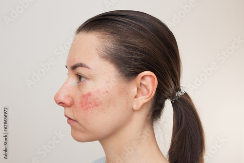 close-up profile of a young dark-haired Caucasian woman suffering from the skin disease rosacea on her face in the acute stage. Pink acne. Dermatological problems. Teenage acne. photo