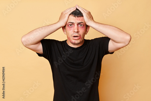 Shocked despair sufferer man in black T-shirt with bruises and abrasions on his face isolated over beige background standing with hands on head has problems with bandits.