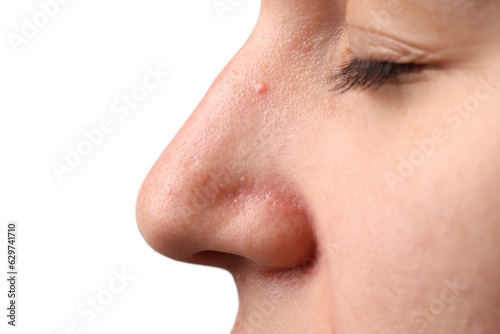 Young woman with acne problem on grey background, closeup