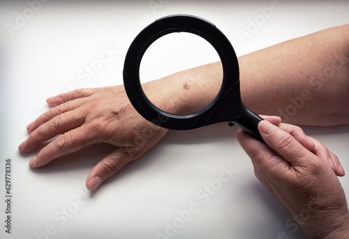 Senior woman examines her big convex mole on hand with magnifying glass. Monitoring of changes in condition of birthmark, exposure to sunlight on the skin, prevention of cancer.
