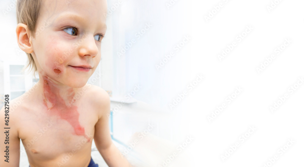 medical procedure dressing a boy with a firstdegree burn from boiling