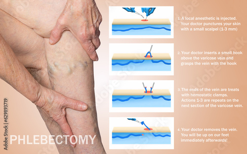 Ambulatory Phlebectomy Treatment for varicose vein. photo