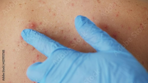 Doctor examines skin full of blisters, scars and rashes caused by varicella chickenpox.