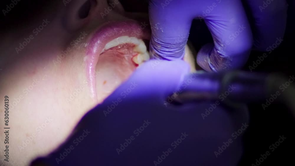 Palitor Real footage of a professional dentist widely brushing the teeth of a ...
