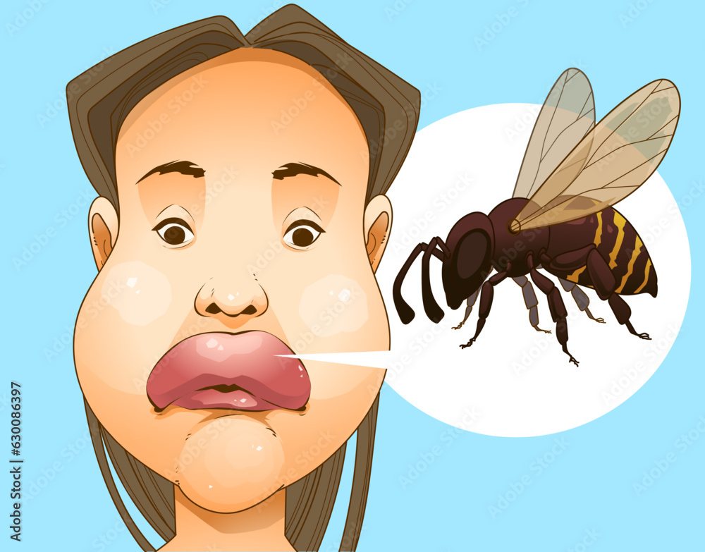 Bee sting. Swollen face. Swollen lips. Injury after a bee sting
