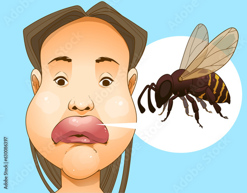 Bee sting. Swollen face. Swollen lips. Injury after a bee sting.  Redness on the skin. Closeup illustration. Healthcare illustration, vector illustration. 
