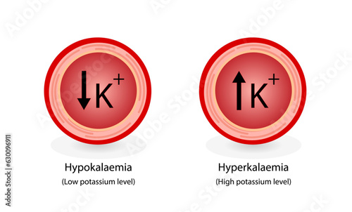 Hyperkalaemia, high plasma potassium level and Hypokalaemia, low plasma potassium level. Potassium K excess and deficit electrolyte disorders, blood test tube, Scientific design. Vector illustration.