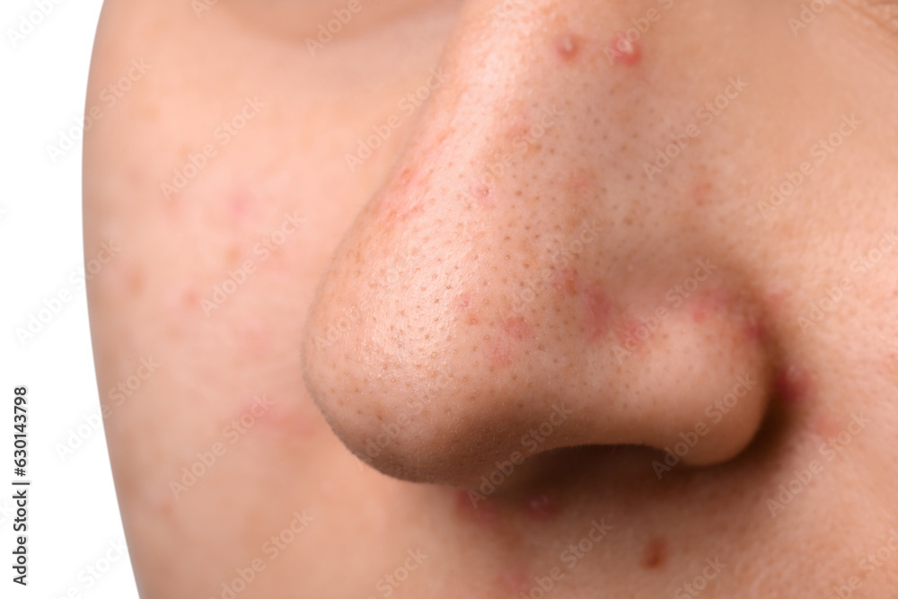 Young woman with acne problem, closeup view of nose Young woman with acne problem, closeup view of nose