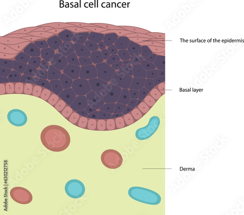 Basal cell cancer. Skin disease. Tumor cells.