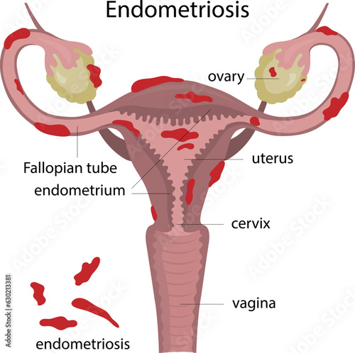 Vector illustration endometriosis. Gynecological disease. Inflammation of the uterus. Diseases of female organs.