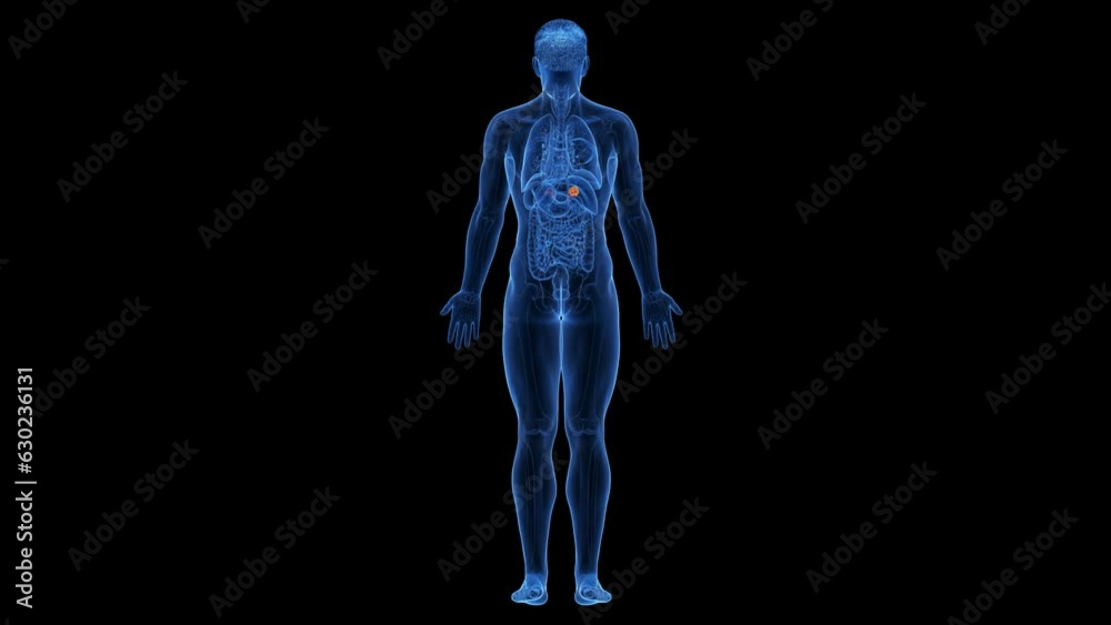 Animation of a malignant tumor in a man's adrenal gland
