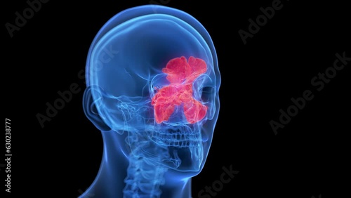 Animation of inflammation of Animation of sinuses