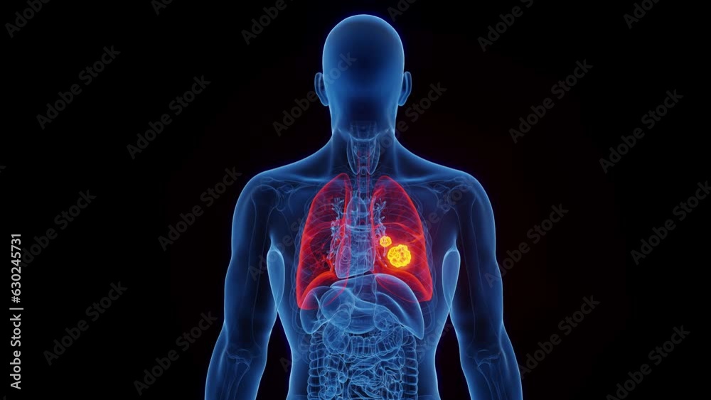 Animation of cancerous growths in a man's right lung Animation of cancerous growths in a man's right lung