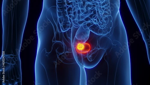 Animation of renal bladder cancer in human male photo