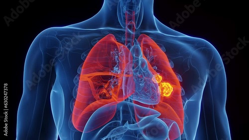 Animation of lung cancer in a human male