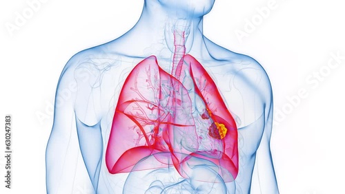 Animation of cancerous tumors in a man's left lung photo