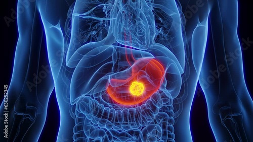 Animation of malignant growth in a man's stomach