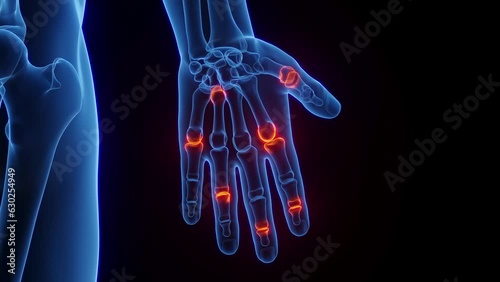 Animation of male skeleton with inflamed hand