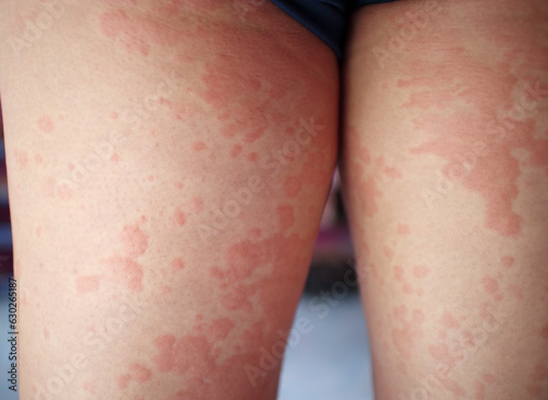 Dermatitis, Asian man, man pinches leg allergy, allergic reaction, insect bites, hand scratching, itchy red spots or skin rash. beauty problems from medical treatment photo