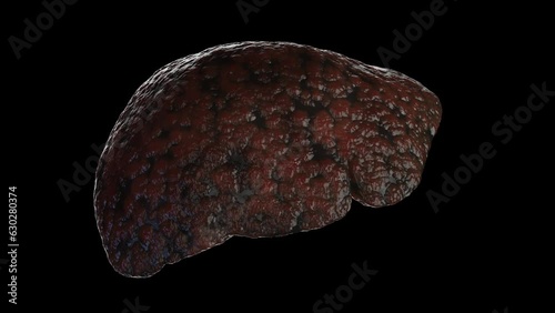 Animation of a man's cirrhotic liver photo