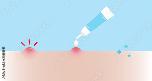 How to use acne pimple treatment for papule vector illustration on sky blue background. Step of use, direction for use acne cream, gel and lotion absorbing inflammatory acne on skin face.