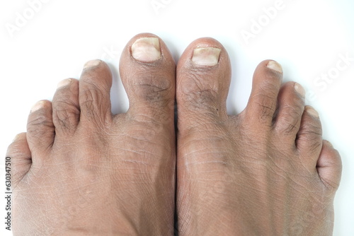 A close up of a toenail  psoriasis with a white background.