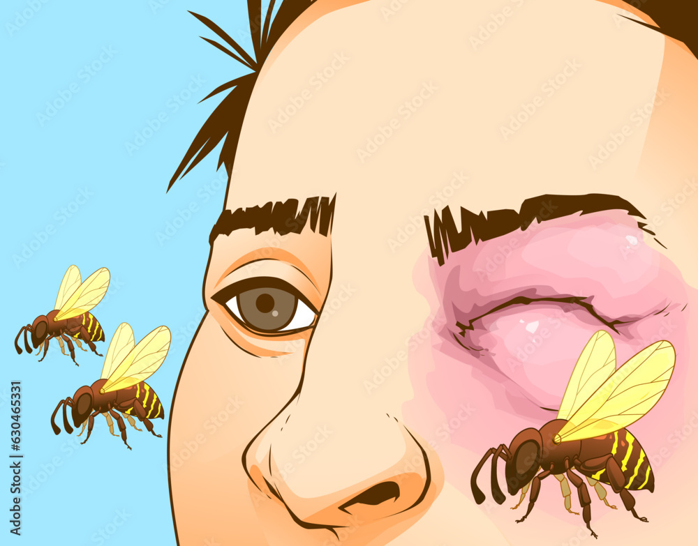 Bee sting. Swollen face. Swollen eye. Injury after a bee sting. Redness