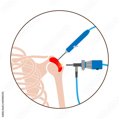 Shoulder arthroscopy poster photo