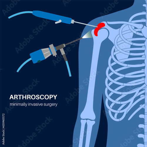 Shoulder arthroscopy poster