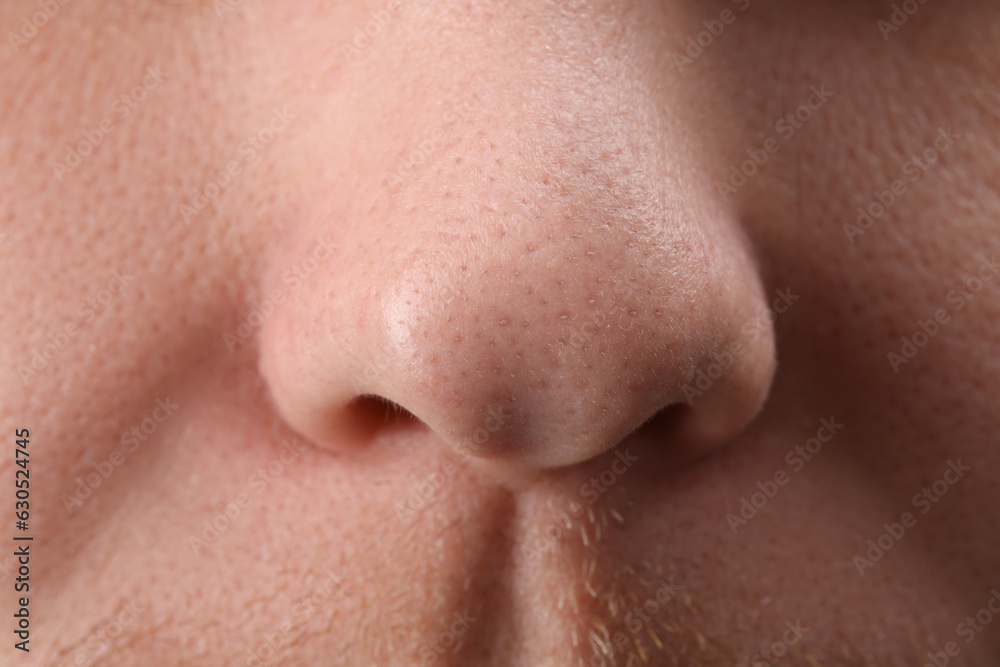 Young man with acne problem, closeup view of nose Young man with acne problem, closeup view of nose