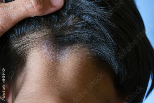 Closed up of ringworm (tinea) on head of Asian girl (Dermatitis). skin with psoriasis. Seborrheic dermatitis. Chronic inflammation on the skin) Appears as a red, itchy and scaly dandruff on the head. photo