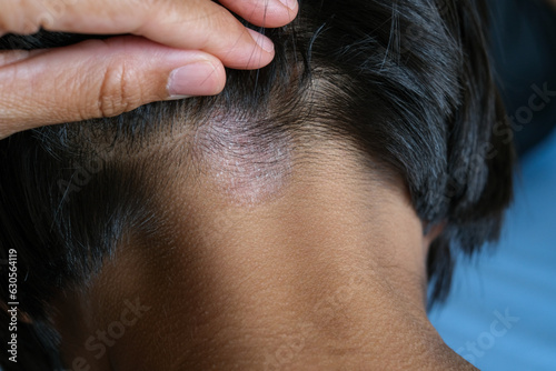 Closed up of ringworm (tinea) on head of Asian girl (Dermatitis). skin with psoriasis. Seborrheic dermatitis. Chronic inflammation on the skin) Appears as a red, itchy and scaly dandruff on the head.