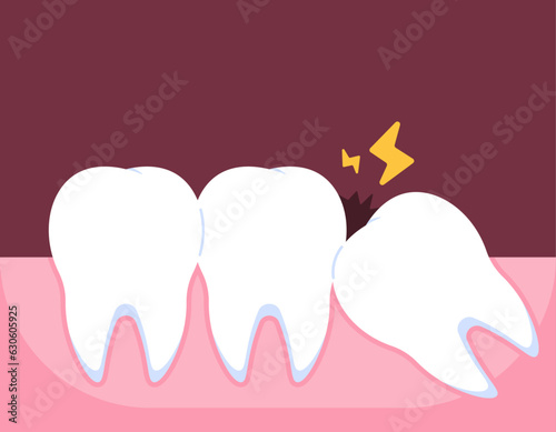 Illustration of a wisdom tooth that is starting to grow. Wisdom teeth grow obliquely. the onset of pain due to tooth impaction. problems and pain. illustration concept design. vector elements