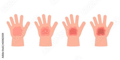 Burn of hand child skin different degree. First aid for fire or chemical injury skin. Visual symptom burn. Vector