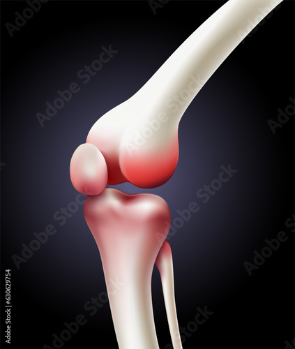 Skeletal flexion at the knee joint showing the cause of painful osteoarthritis. vector illustration file.