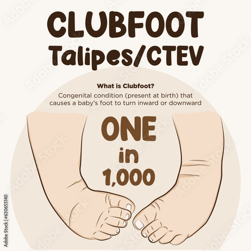 Line art vector of clubfoot. Foot turn inward or upward. Type of clubfoot infographic photo