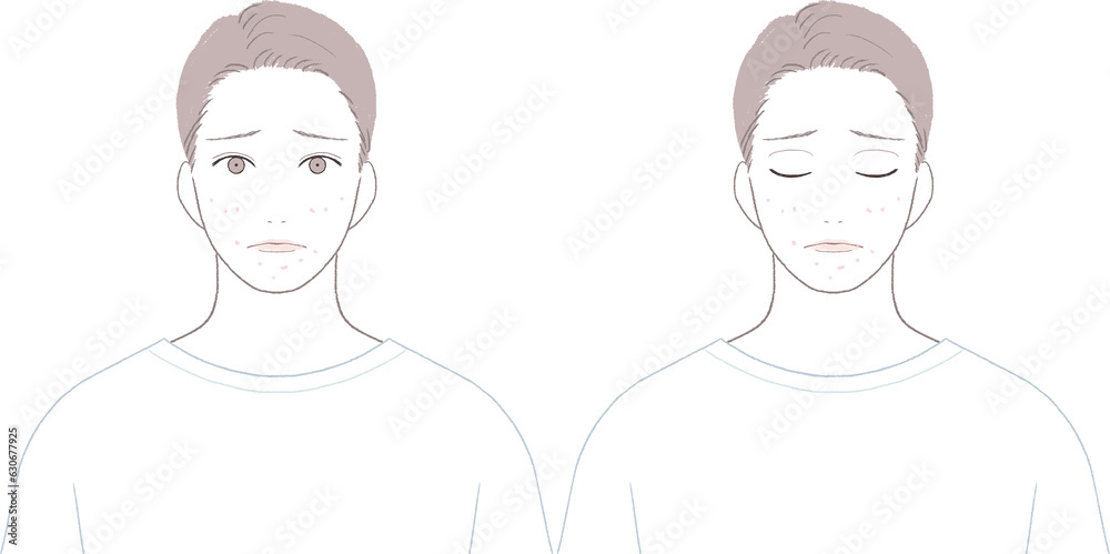 ニキビに悩む男性 ニキビに悩む男性