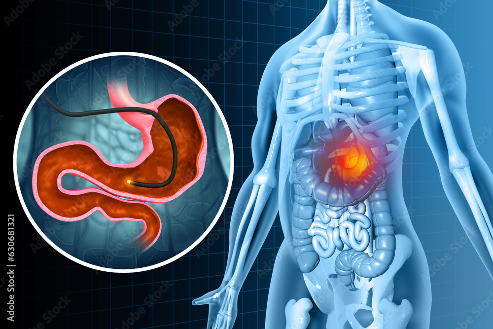 Human Stomach with endoscope and closeup view of bacterium