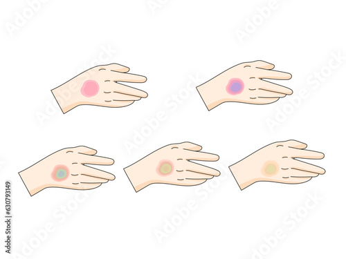 bruise stages diagram schematic vector illustration. Medical science educational illustration
